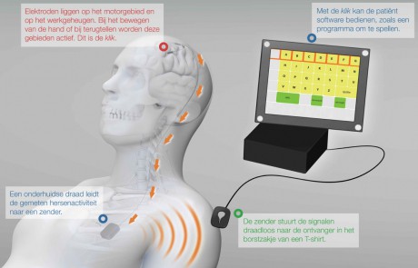 ALSopdeweg! - UMC Neuroprothese